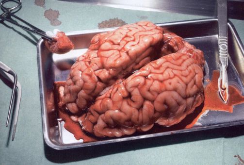 Cerveau humain