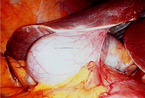 Organe Vésicule biliaire